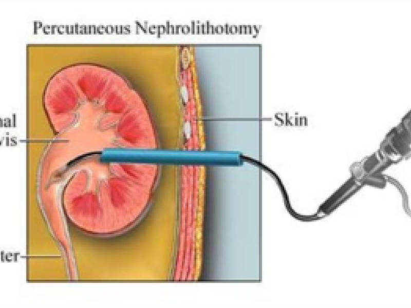 percutaneous